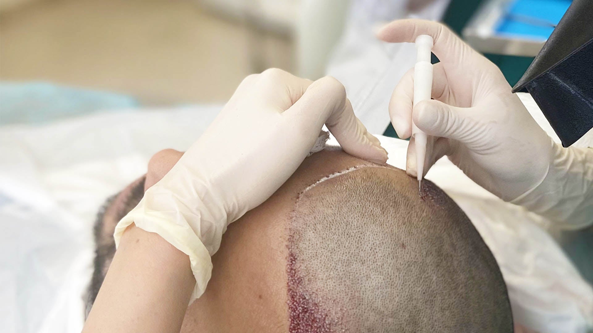 The No.1 Hair Transplant Clinic in Greece and Cyprus